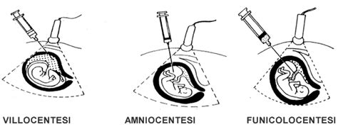 Ecografia durante villocentesi