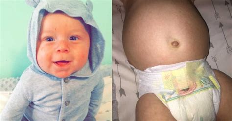 Baby with swollen belly