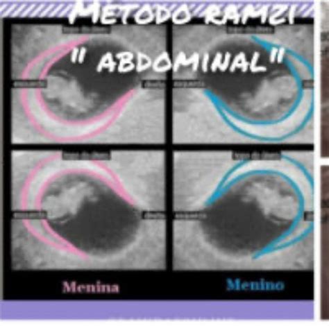 Schema illustrativo della posizione placentare ipotizzata dal metodo Ramzi