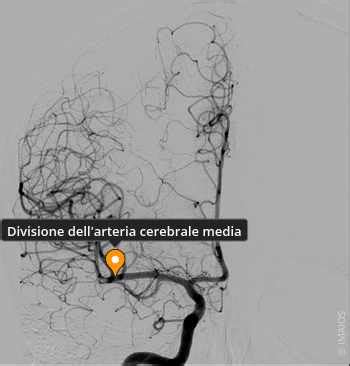 Immagine ecografica di Doppler dell'arteria cerebrale media con ridistribuzione del flusso
