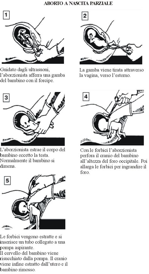 Rappresentazione grafica dell'aborto a nascita parziale