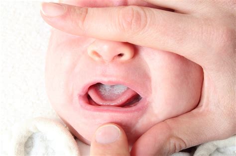 Mughetto in bocca neonato
