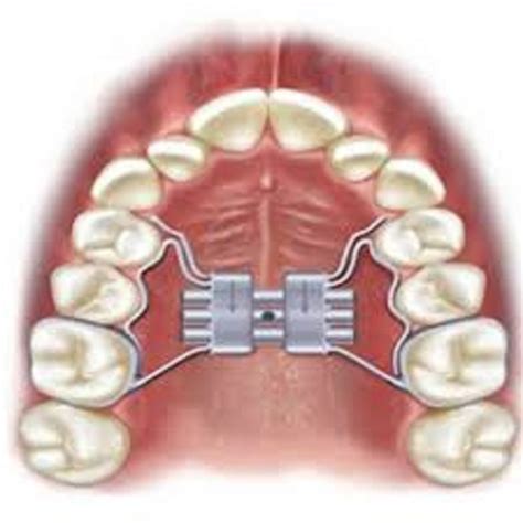 bambino con apparecchio ortodontico espansore palatale