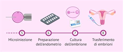 Schema del processo di microiniezione intracitoplasmatica (ICSI)