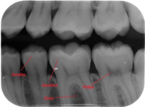 Radiografia dentale e protezione gravidanza