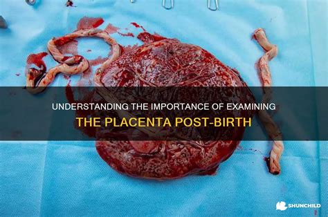 Placenta estratta dopo il parto