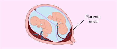 Immagine illustrativa di una Placenta previa che copre il collo uterino