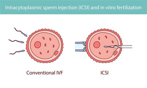 Illustrazione delle diverse tecniche di riproduzione assistita (IUI, IVF, ICSI)