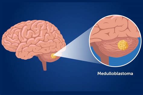 Medulloblastoma nel cervelletto