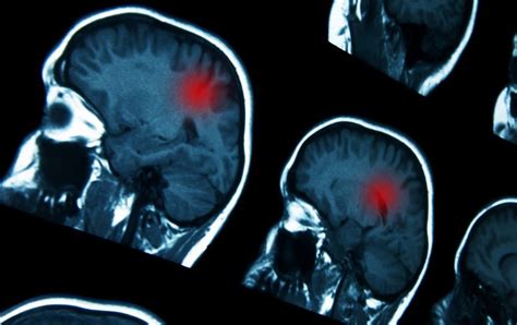 Modalità di trattamento dei tumori cerebrali