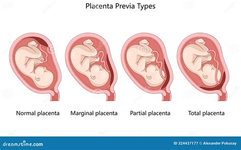 Diagramma che illustra le diverse tipologie di placenta previa