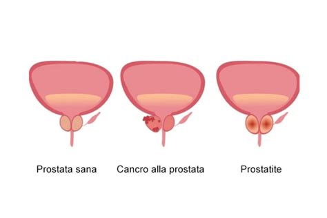 immagine stilizzata di una prostata sana e infiammata