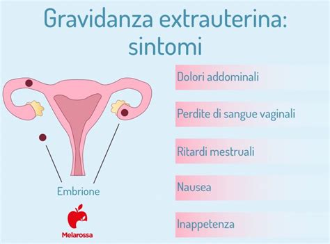 Schema di una gravidanza extrauterina in una tuba di Falloppio