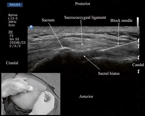 Anatomia sonografica dello iato sacrale e posizionamento dell'ago in guida ecografica