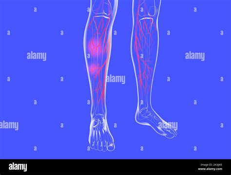 rappresentazione anatomica del sistema venoso delle gambe e delle teleangectasie