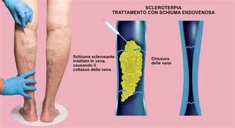 schema grafico a confronto tra scleroterapia e laserterapia per il trattamento dei capillari