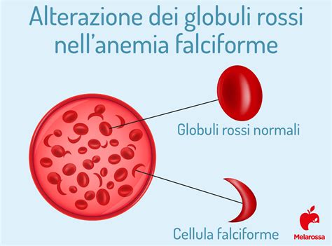 Meccanismo della falcizzazione dei globuli rossi nell'anemia falciforme