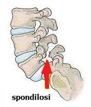 Illustrazione anatomica della colonna vertebrale lombare con segni di spondilosi