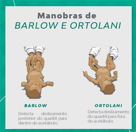manovra di Ortolani in neonato