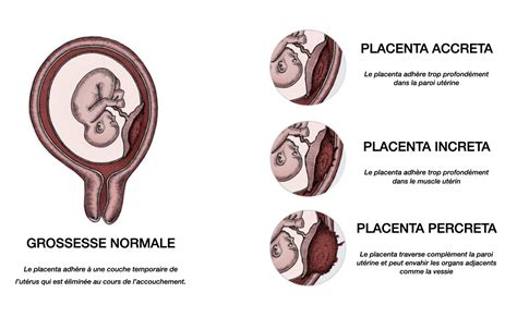 illustrazione della placenta accreta rispetto a quella normale
