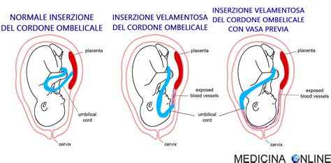 schema illustrativo delle possibili complicazioni del cordone ombelicale