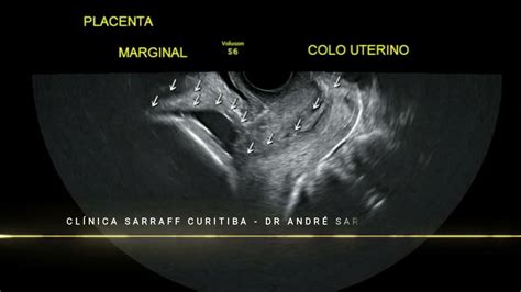 Ecografia che mostra la posizione di placenta previa