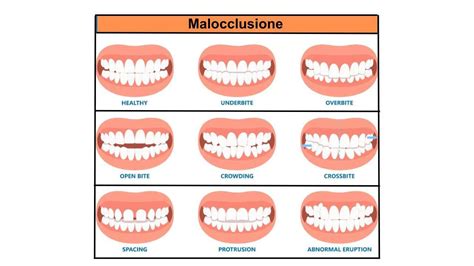 Illustrazione che mostra le diverse tipologie di malocclusione dentale