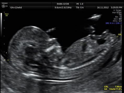 ecografia del primo trimestre che mostra la misurazione della lunghezza vertice-sacro