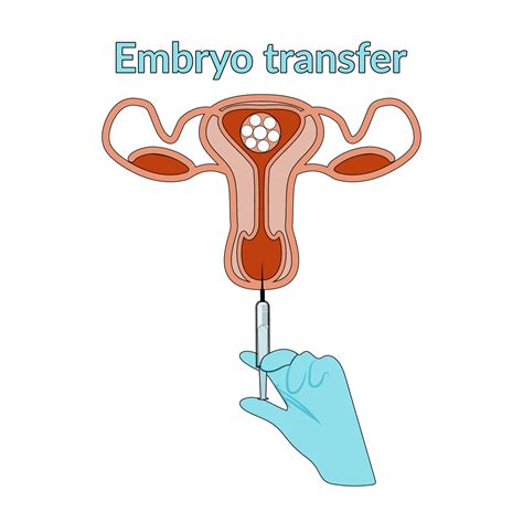 Embryo transfer illustration