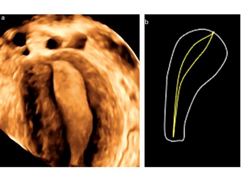 Diagnosi di Utero Unicorno tramite Imaging