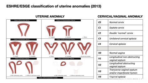 Tipi di Malformazioni Uterine Congenite