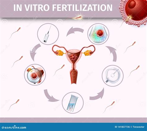 Illustrazione delle tecniche di fecondazione in vitro