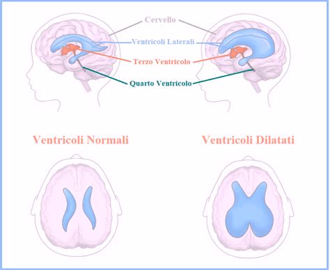 Schema di Ventricolomegalia Fetale