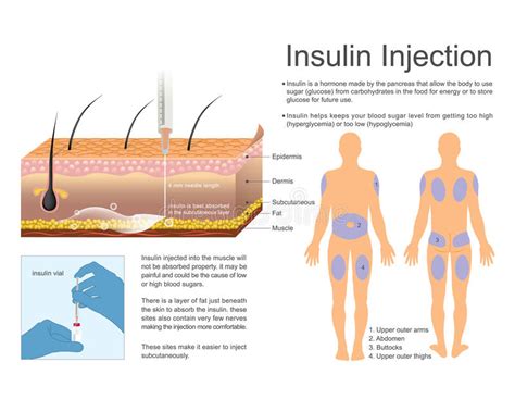 Iniezione Insulina