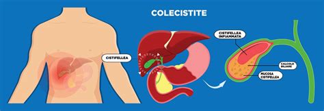 Illustrazione delle complicanze dei calcoli biliari (colecistite, pancreatite)