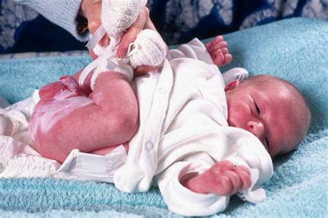 Bambino con dermatite da pannolino sui glutei