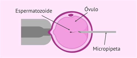 Immagine dettagliata che illustra la procedura di micro-iniezione ICSI con un micro-ago