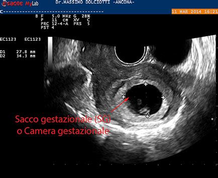 Sviluppo iniziale della camera gestazionale e sacco vitellino