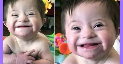 Bambina con Sindrome di Rett e il suo sorriso