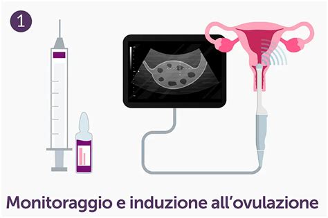 Illustrazione schematica dell'inseminazione intrauterina (IUI)