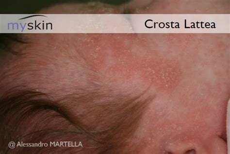 rappresentazione schematica della crosta lattea sul cuoio capelluto del neonato