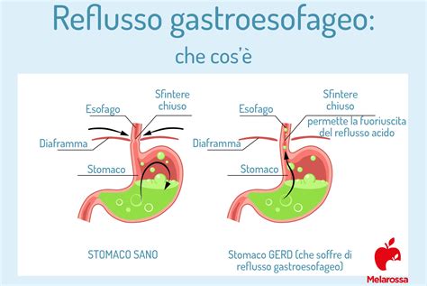 Sintomi del reflusso gastroesofageo nel neonato