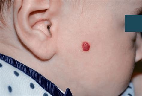 rappresentazione schematica di un emangioma infantile sulla pelle