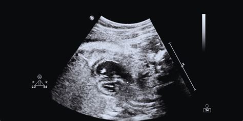 Immagine di un'ecografia fetale del primo trimestre