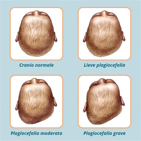 Diagramma cranio neonato plagiocefalia