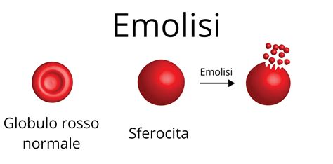 Diagramma che illustra il processo di emolisi dei globuli rossi fetali da parte di anticorpi materni