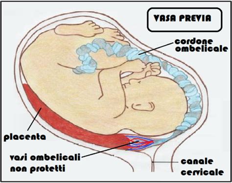 Illustrazione dell'inserzione velamentosa del cordone ombelicale con vasa previa
