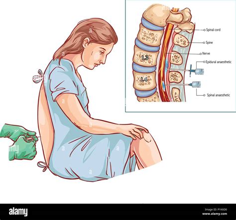 Donna incinta che riceve un'iniezione epidurale