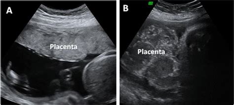 Ecografia di una placenta matura