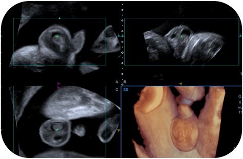 Ecografia di una placenta di Grado I con lievi calcificazioni